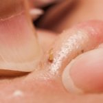 11 способов очистить кожу от сальных пробок и избавиться от угревой сыпи