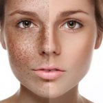 Achromin for age spots - composition and effectiveness of the cream