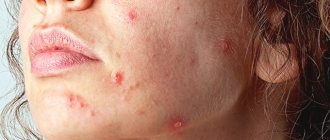 actinic keratosis photo