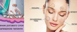 Diamond microdermabrasion of the face - what is it, devices, creams for enzyme micropeeling. Price of the procedure 