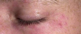 Атопический дерматит вокруг глаз