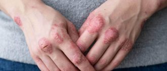 Atopic dermatitis