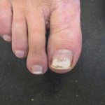 white toenails