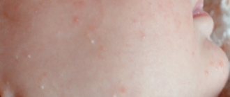 White pimples in a newborn