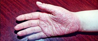 Plaque-fan-shaped (vulgar) form of palmoplantar psoriasis