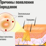 Бородавки причины