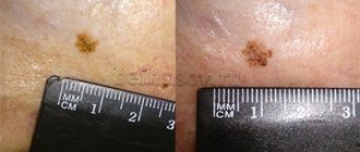 Rapid growth of a mole—up to two centimeters per year—is considered dangerous.