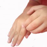 Scabies in children