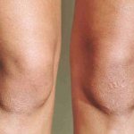 Что делать, если шелушится кожа на коленях?