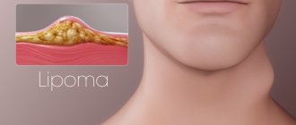 What is a lipoma and why does it appear?