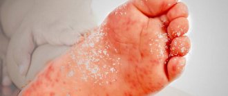 What causes a rash on a child&#39;s feet?