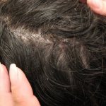 дерматит волосистой части головы