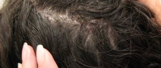 дерматит волосистой части головы