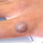 Дерматофиброма на руке