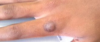 Дерматофиброма на руке