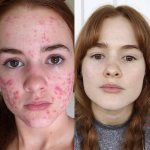 Before and after acne, stories of girls who were able to overcome acne