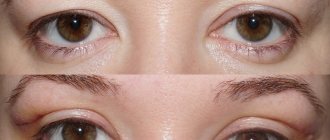 Before and after upper eyelid blepharoplasty