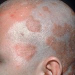 Eczema on the head - photo