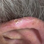 ECZEMA OF THE EAR OR EXTERNAL AUDITORY CANAL2.jpg