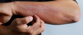 Eczema