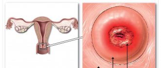 Cervical erosion