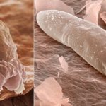 photo demodex