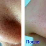 фото до и после удаления черных точек на носу