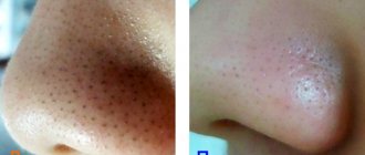 Photos before and after removal of blackheads on nose