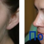 Photos before and after removing a mole on the face using a laser