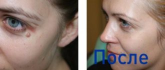 Photos before and after removing a mole on the face using a laser