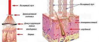 Fractional non-ablative laser rejuvenation