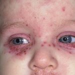 Hemorrhagic rash around the eyes