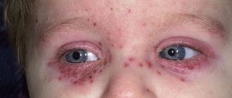 Hemorrhagic rash around the eyes