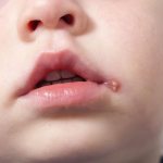 Herpes in children: how to treat?