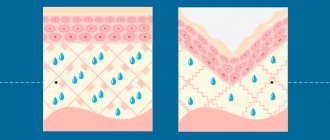 Hyaluronic acid for facial skin