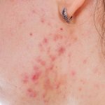 Pustular skin diseases