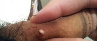 abscess on penis