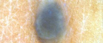 blue nevus photo