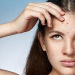 Hormonal therapy for acne