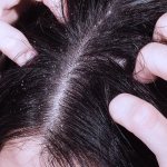 Грибок кожи головы: симптомы, лечение и профилактика Фото 1