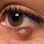 Chalazion