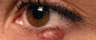 Chalazion