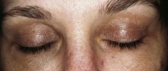 Chloasma on the eyelids