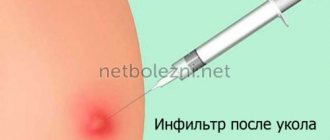 Infiltration after injection