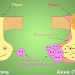 Как избавиться от прыщей на попе быстро, за 1 день. Причины и лечение