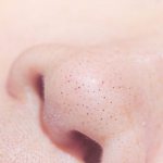 How to get rid of closed and open comedones on the face