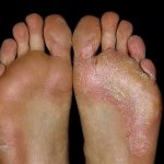 How to treat heel fungus with folk remedies, what does white plaque mean?