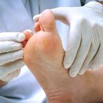 how to treat a callus and how to remove a wart