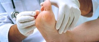 how to treat a callus and how to remove a wart