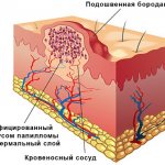 Как лечить шипицу на ступне у ребенка. Фото, причины